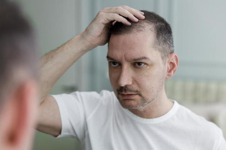 Erkekleri kelliğe sürükleyen gizli tehlike. Herkes içer ama sonuç felakettir; saçları avuç avuç dökülür.