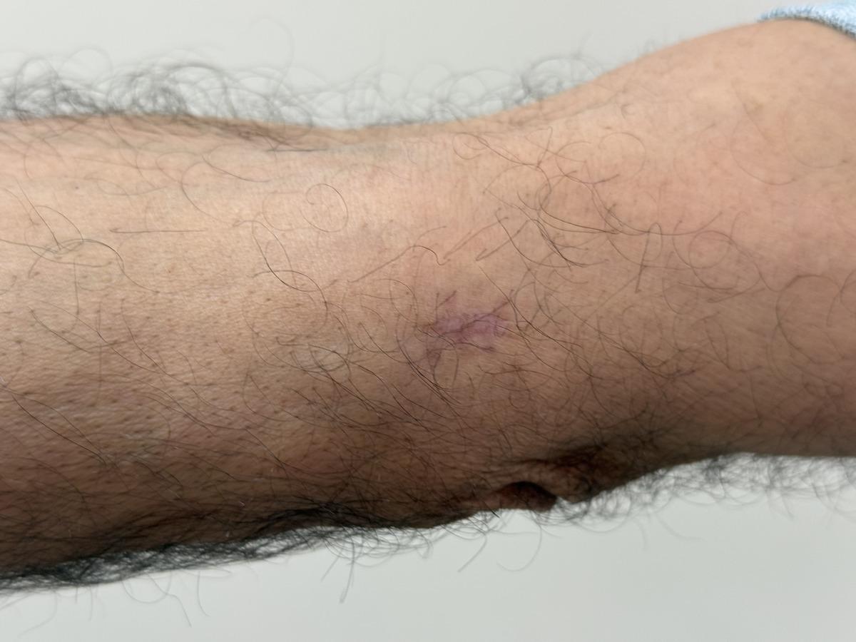 Kendini 1 cm yaraladı ve kanser olduğunu öğrendi! 2